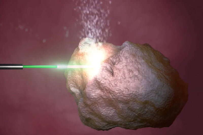LITIASIS laser